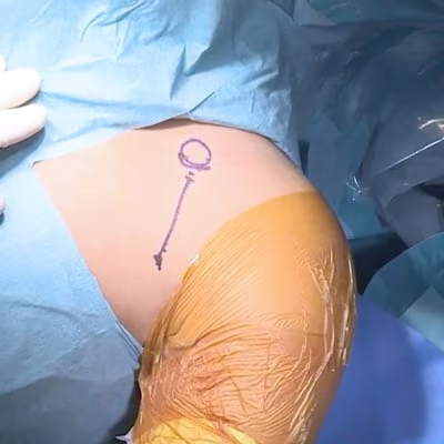 Accueil 3 arthroscopie epaule